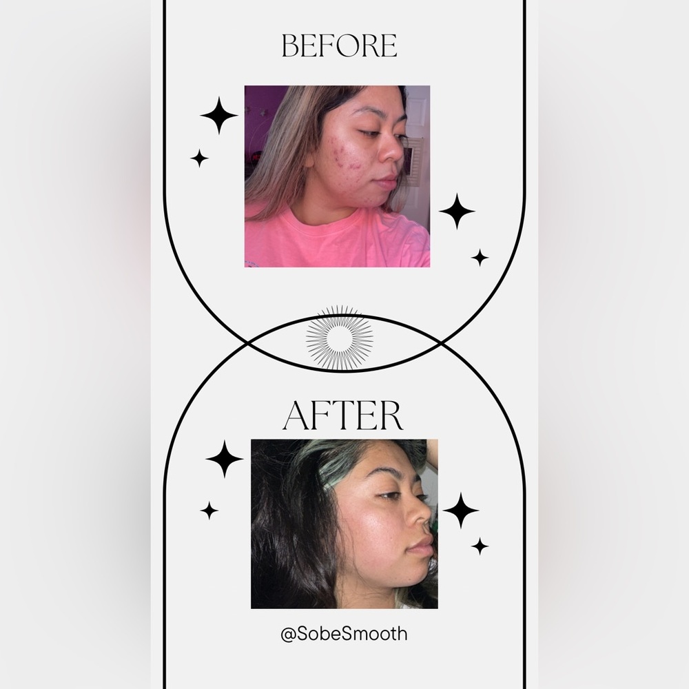 Acne And Anti-aging